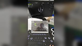 Arabalı renkli doppler Ultrason Teşhis Sistemi BR-US01